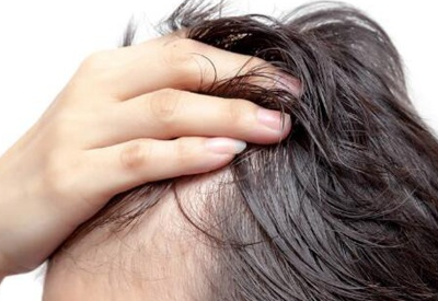 长期大量掉头发可能与这些元素的缺乏有关